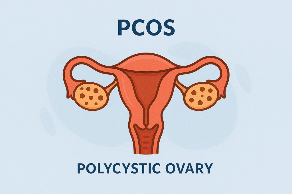 PCOS